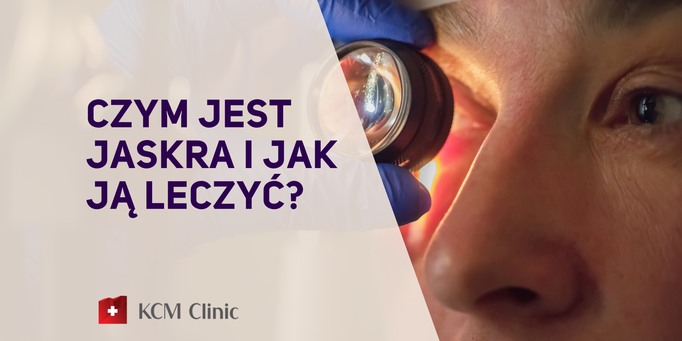 Czym Jest Jaskra I Jak Ją Leczyć Kcm Clinic 9122