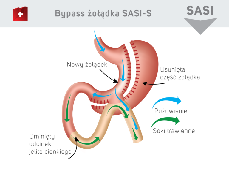 Chirurgiczne Leczenie Otyłości Bariatria Leczenie Bariatryczne Ośrodek Klinika Kcm Clinic 7282