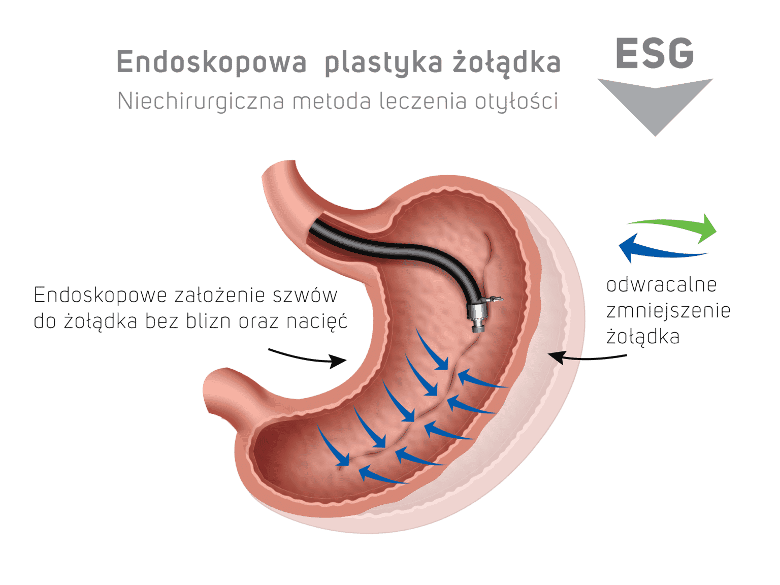 Chirurgiczne Leczenie Otyłości Bariatria Leczenie Bariatryczne Ośrodek Klinika Kcm Clinic 6171